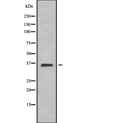 AF9021 at 1/100 staining Human liver cancer tissue by IHC-P. The sample was formaldehyde fixed and a heat mediated antigen retrieval step in citrate buffer was performed. The sample was then blocked and incubated with the antibody for 1.5 hours at 22¡ãC. An HRP conjugated goat anti-rabbit antibody was used as the secondary