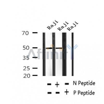 AF2434 at 1/100 staining Human thyroid cancer tissue by IHC-P. The sample was formaldehyde fixed and a heat mediated antigen retrieval step in citrate buffer was performed. The sample was then blocked and incubated with the antibody for 1.5 hours at 22¡ãC. An HRP conjugated goat anti-rabbit antibody was used as the secondary