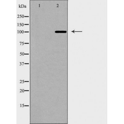 DF6641 at 1/100 staining Human brain cancer tissue by IHC-P. The sample was formaldehyde fixed and a heat mediated antigen retrieval step in citrate buffer was performed. The sample was then blocked and incubated with the antibody for 1.5 hours at 22¡ãC. An HRP conjugated goat anti-rabbit antibody was used as the secondary